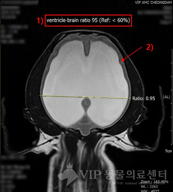 MRI검사 1.jpg