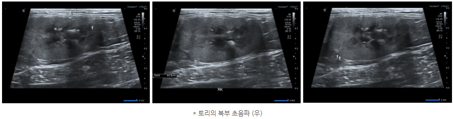 복부초음파 우.png