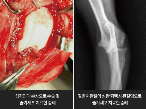 줄기세포 치료효과 관절재생치료 이미지