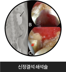 신정결석 쇄석술 이미지