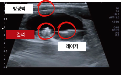 무절개 결석수술 이미지