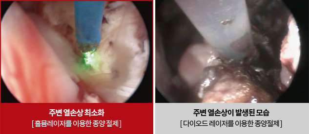 홀뮴야그 레이저(Holmium-YAG Laser) 주변 열손상 이미지